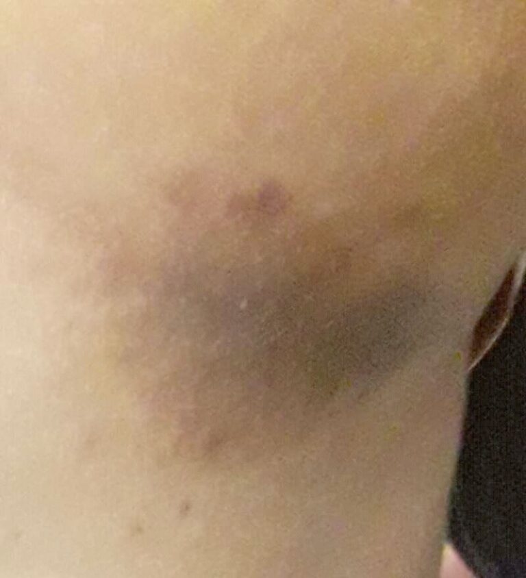 La cellulite : Causes, prévention et traitement de cette pathologie qui affecte plus les femmes