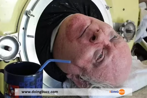 Paul Alexander : L'Homme Au Poumon D'Acier Est Mort