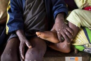 Épidémie De Mpox : La Thaïlande Signale Le Premier Cas D&Rsquo;Asie