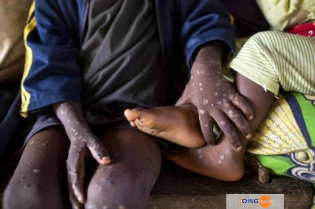 Mpox, Épidémie De Mpox, Thaïlande Premier Cas