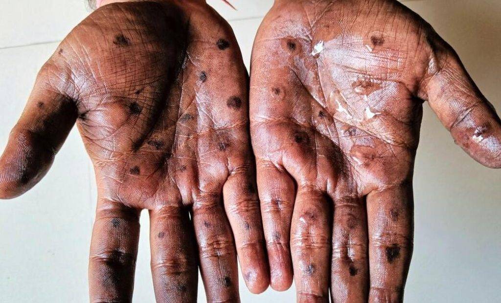 Variole du singe : L’OMS approuve pour la première fois un vaccin