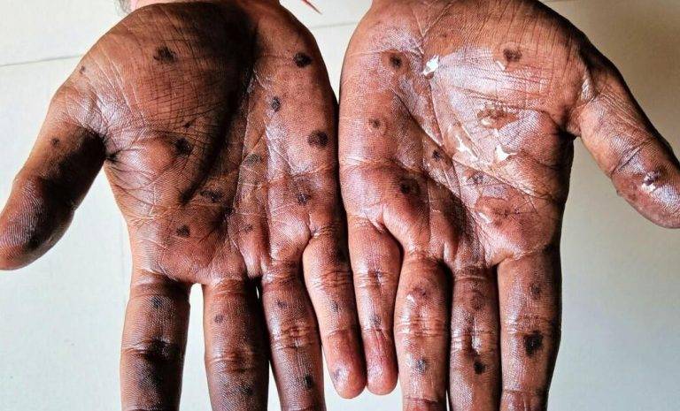Variole du singe : L’OMS approuve pour la première fois un vaccin