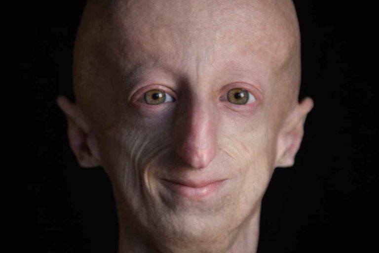 Sammy Basso : Souffrant de la même maladie que Grand P, il meurt de vieillesse à 28 ans